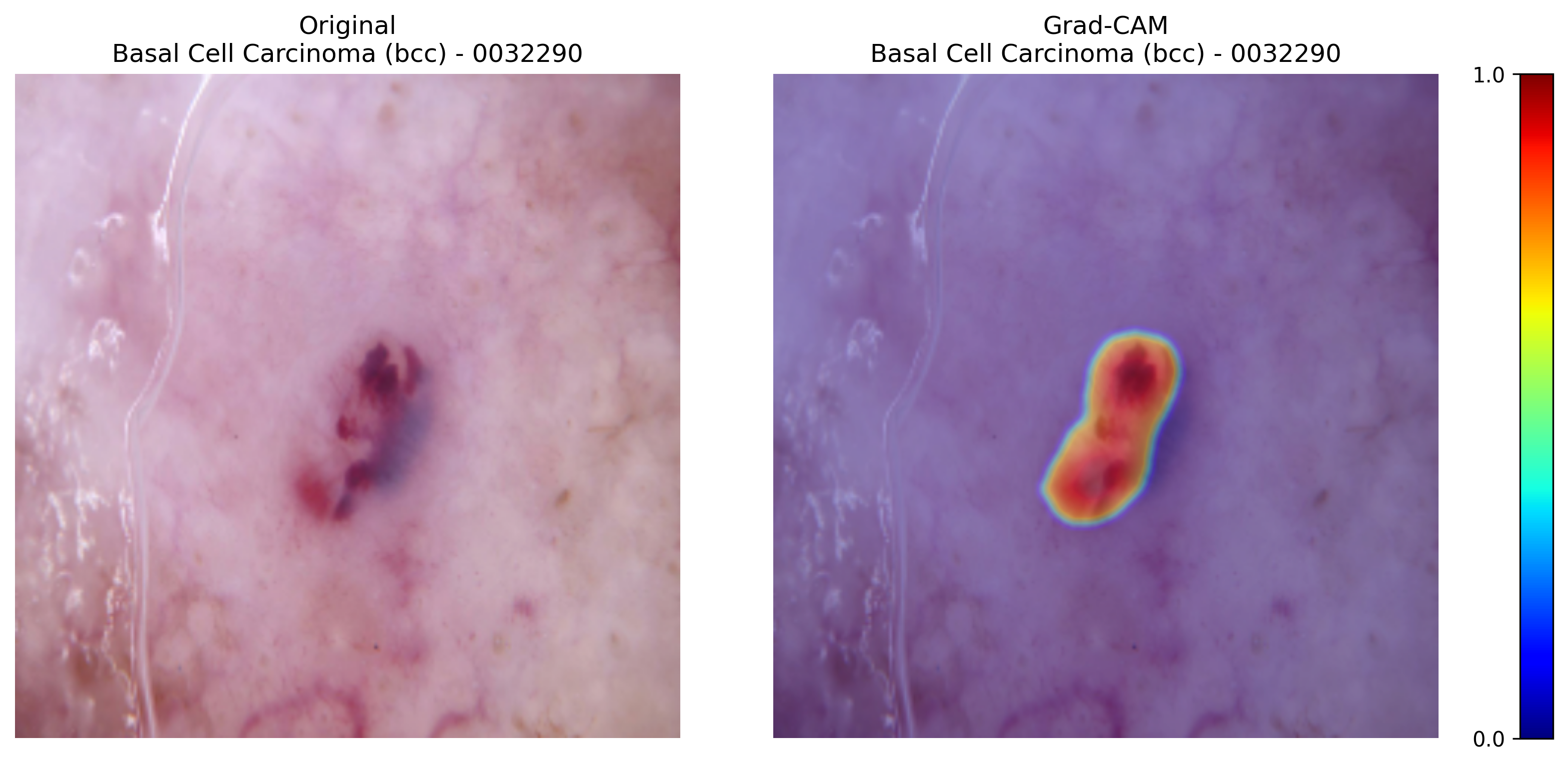 Grad-CAM for Basal Cell Carcinoma