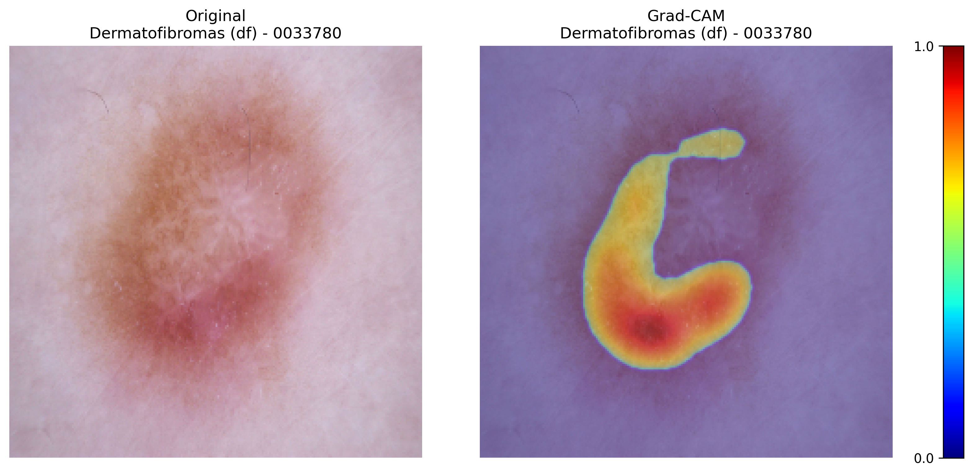 Grad-CAM for Dermatofibroma