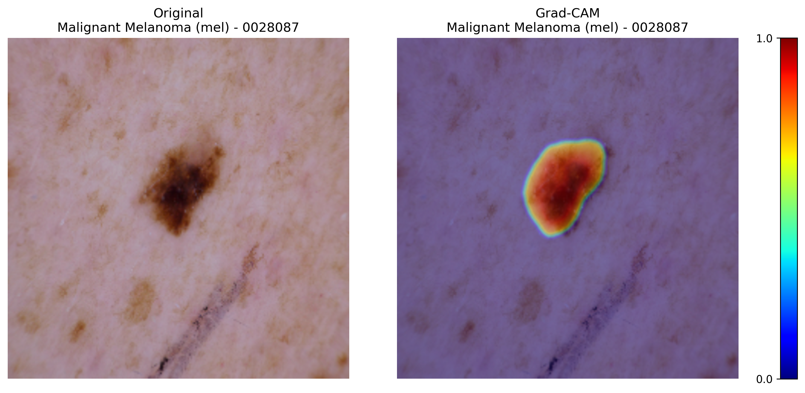 Grad-CAM for Malignant Melanoma