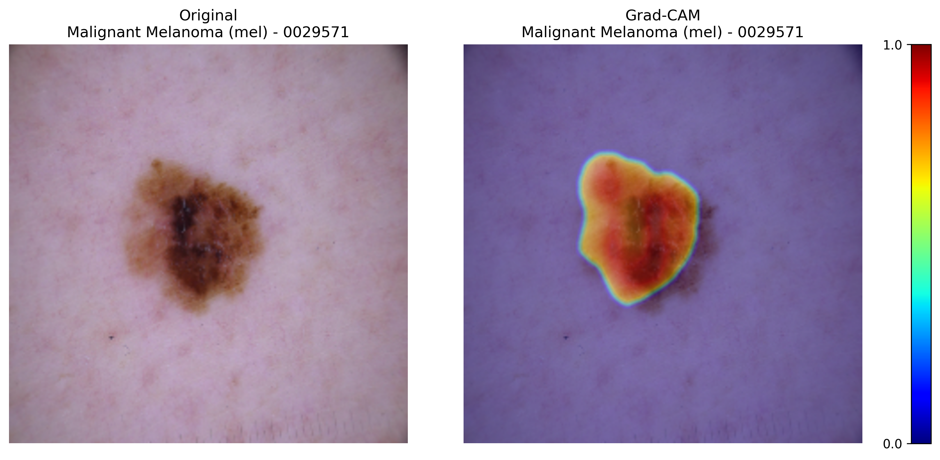 Grad-CAM for Malignant Melanoma