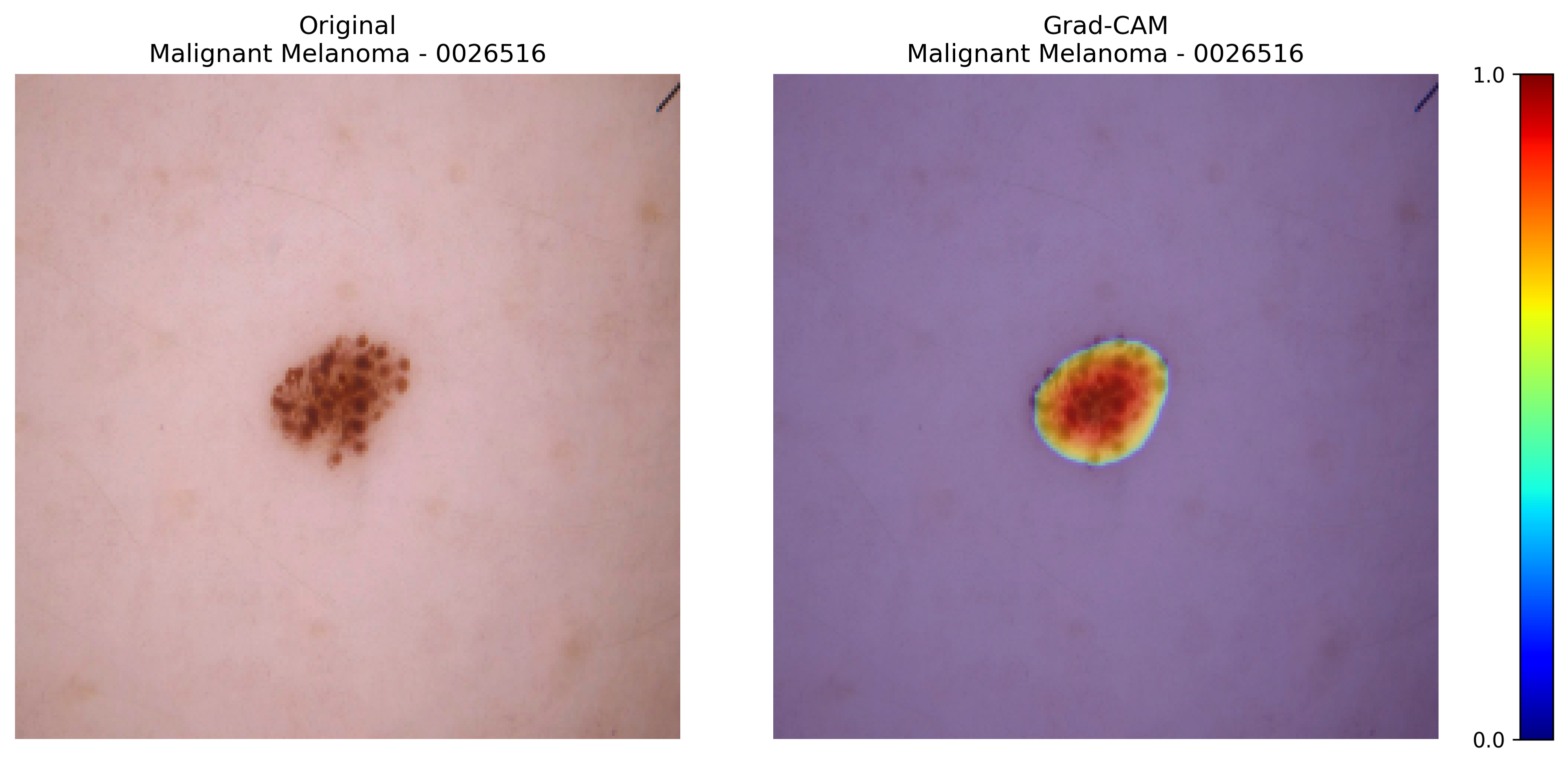 Grad-CAM for Malignant Melanoma