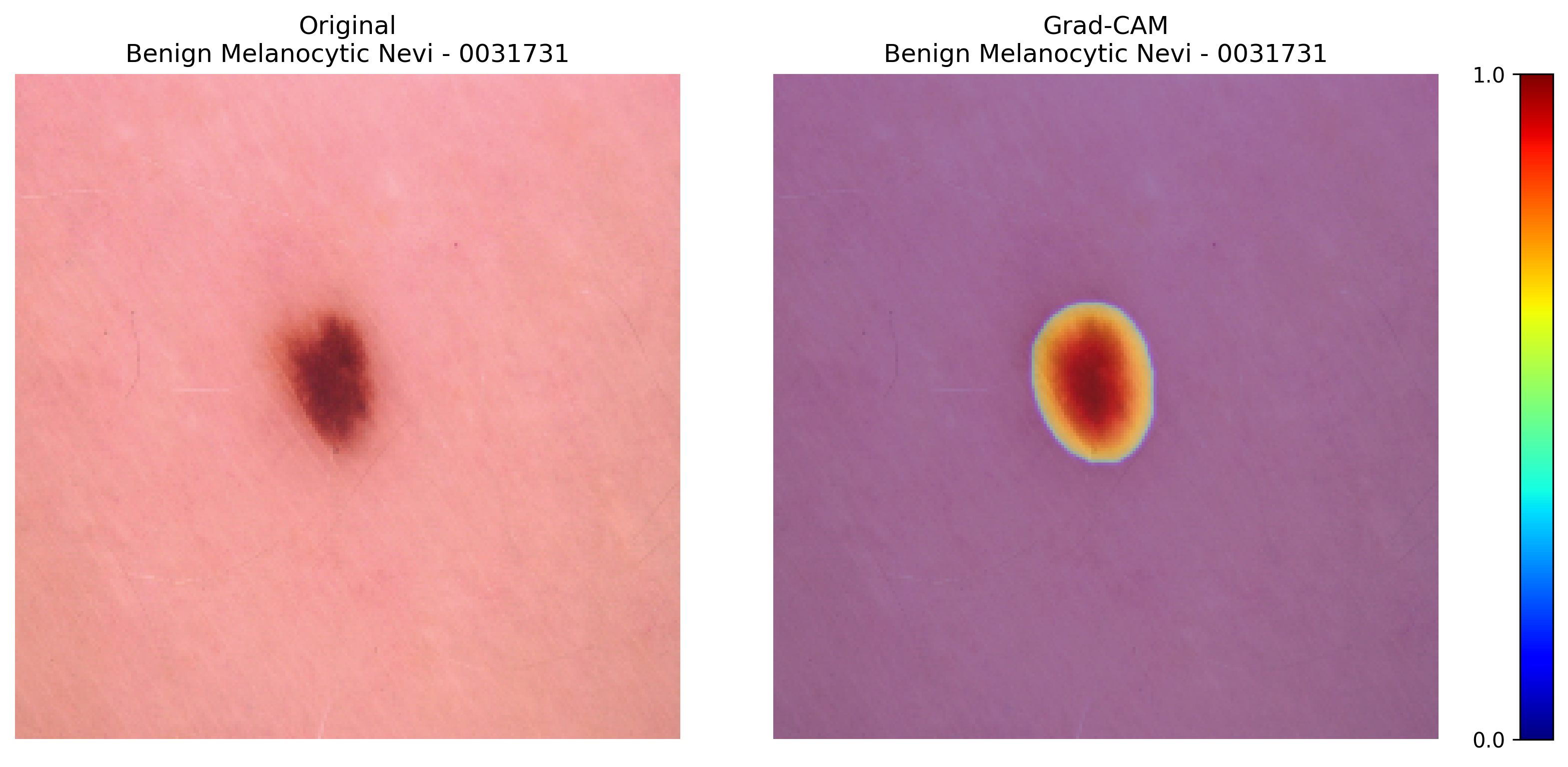 Grad-CAM for Benign Melanocytic Nevi