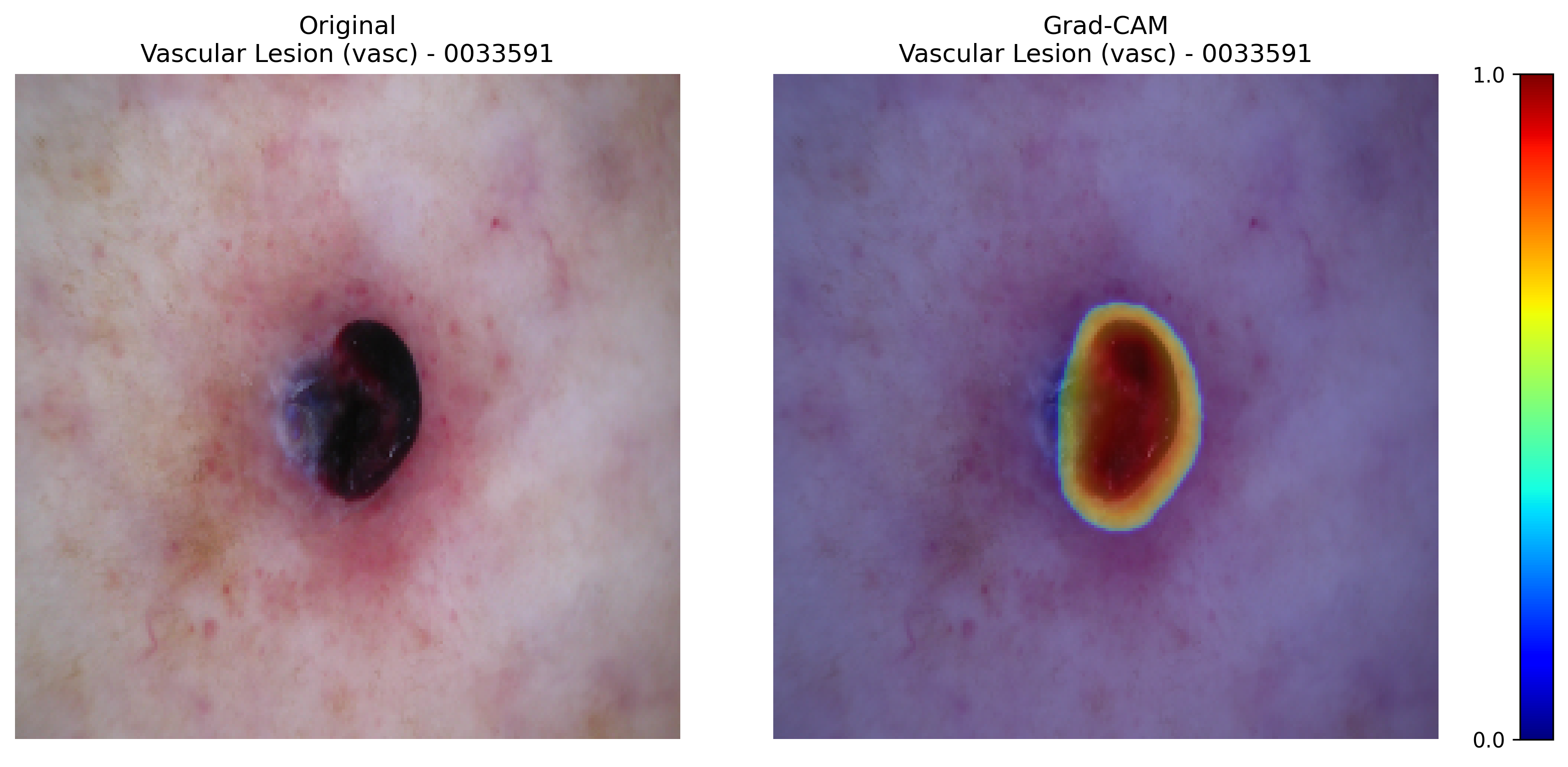 Grad-CAM for Vascular Lesion